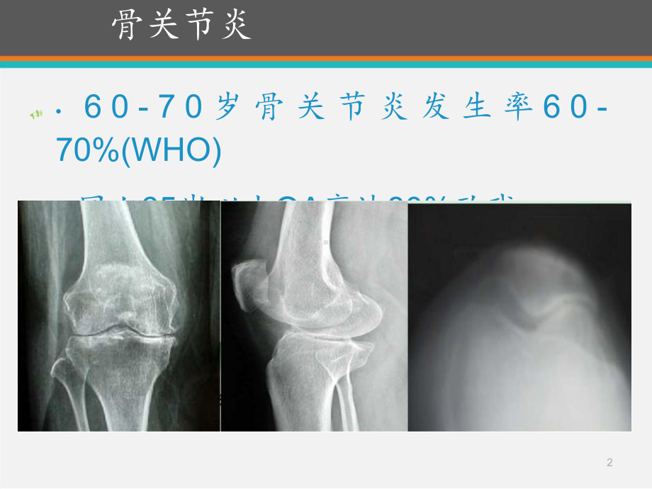 膝关节骨性关节炎的关节镜治疗-ppt课件.ppt_第2页