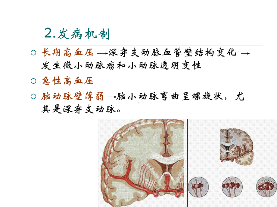 脑出血治疗PPT课件.ppt_第3页