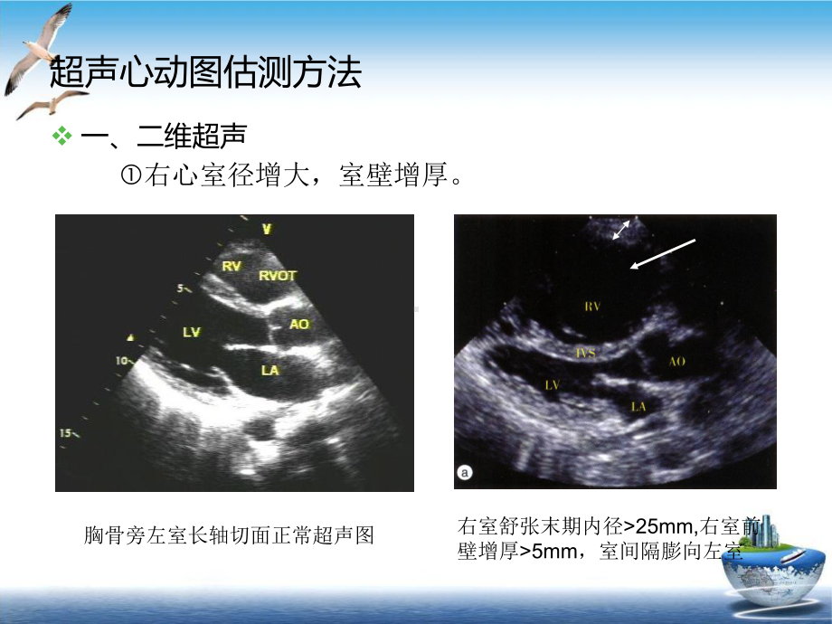 肺动脉高压的超声估测量方法参考课件.ppt_第2页