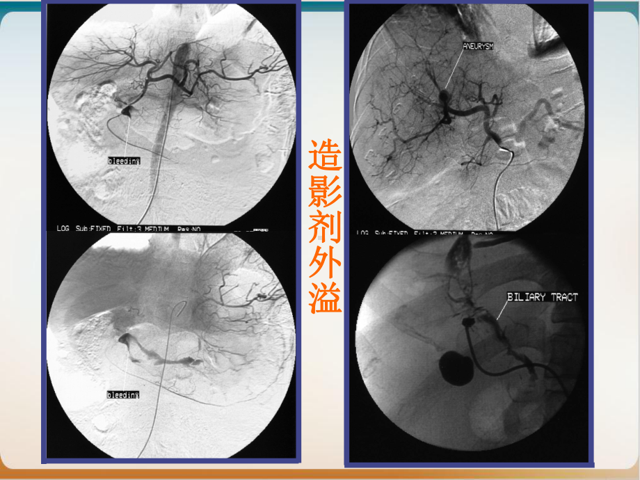 消化道出血的动脉造影诊断和实用PPT课件.pptx_第3页