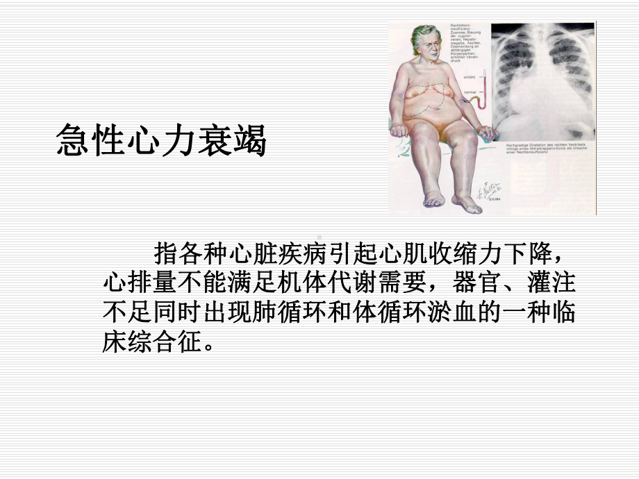 急性心力衰竭的急救护理ppt课件.ppt_第3页