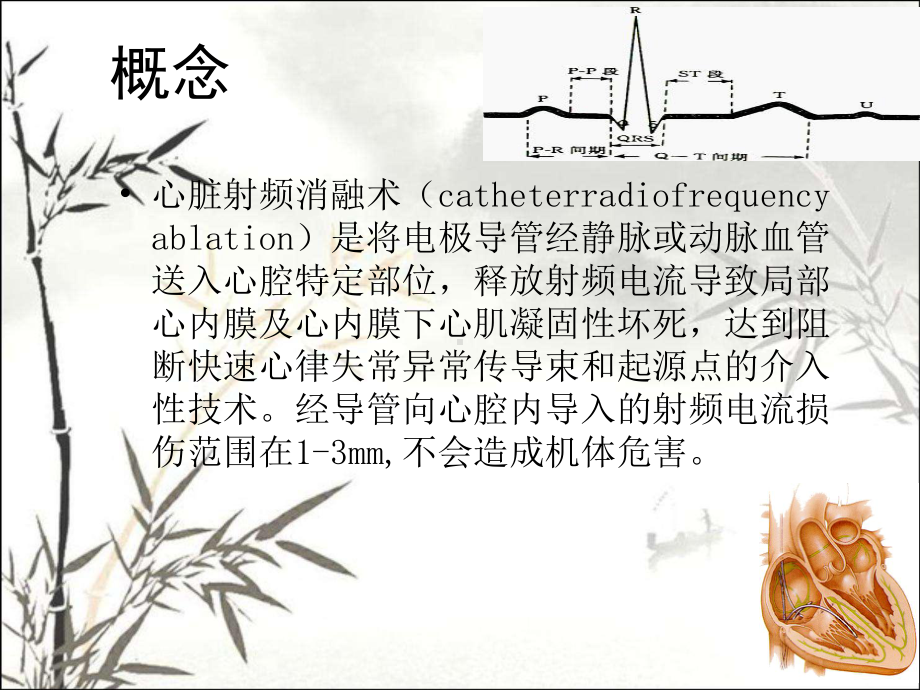 心脏射频消融术ppt课件.ppt_第2页