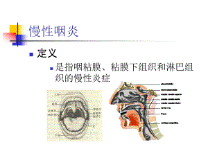 急慢性咽炎扁桃体炎扁桃体周围脓肿课件.pptx