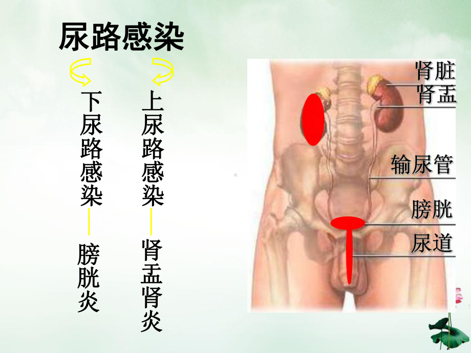 急性肾盂肾炎PPT课件.ppt_第2页