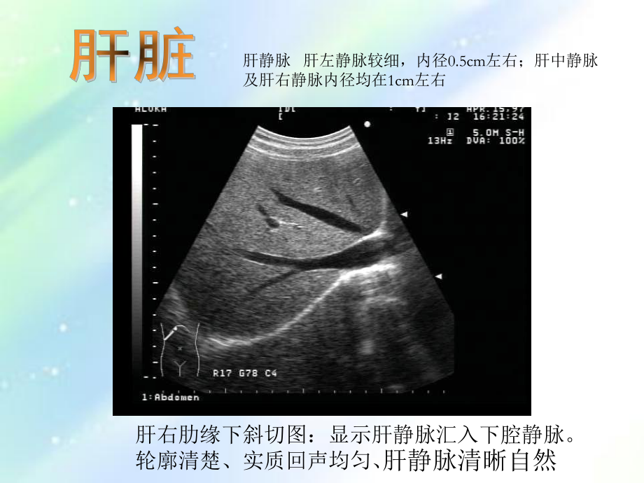 常见病B超图谱-PPT课件.ppt_第2页