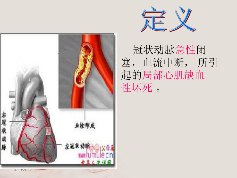 急性心肌梗死的溶栓护理查房课件.pptx_第3页