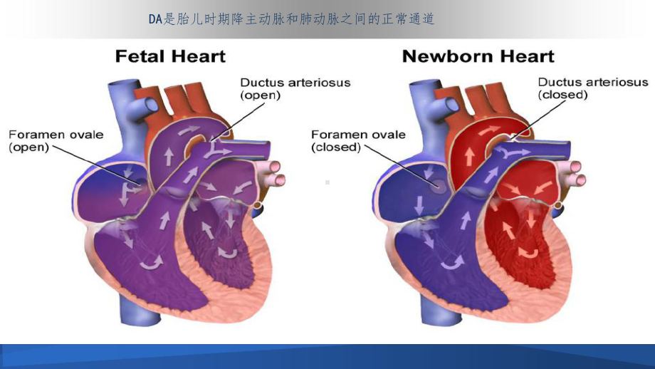 早产儿动脉导管开放ppt课件.ppt_第2页