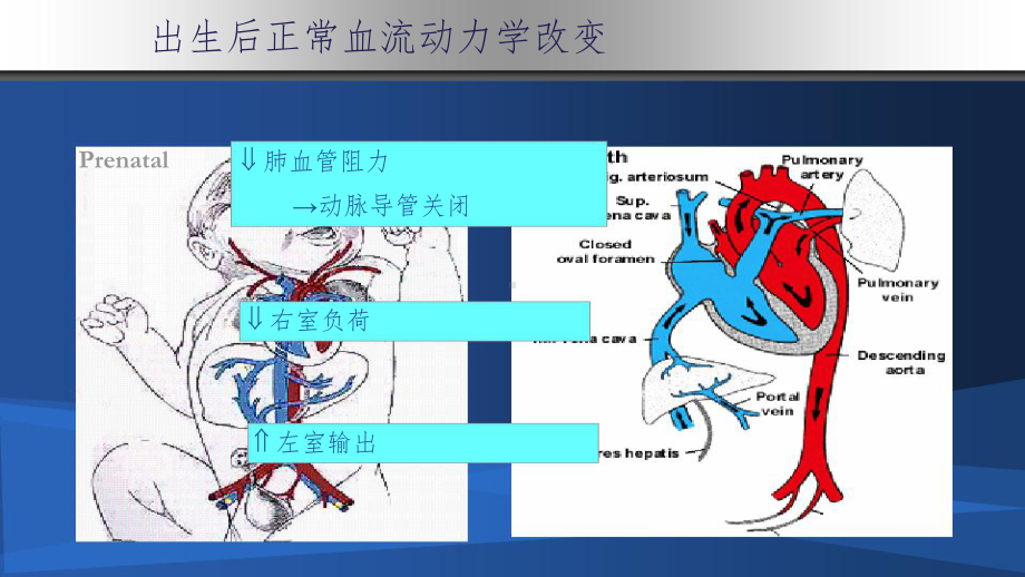 早产儿动脉导管开放ppt课件.ppt_第3页