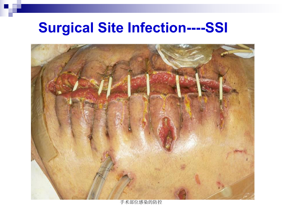 手术部位感染的防控-ppt课件.ppt_第3页