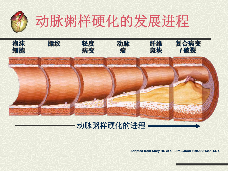 急性心肌梗死健康宣教课件.pptx_第3页