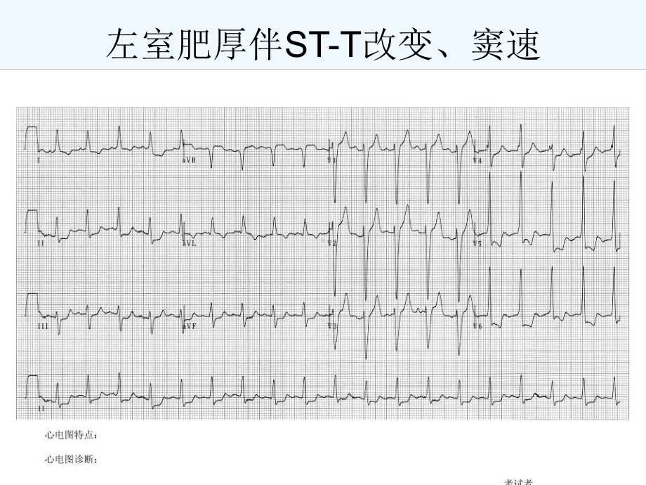 心电图考试完整(ppt)课件.ppt_第3页