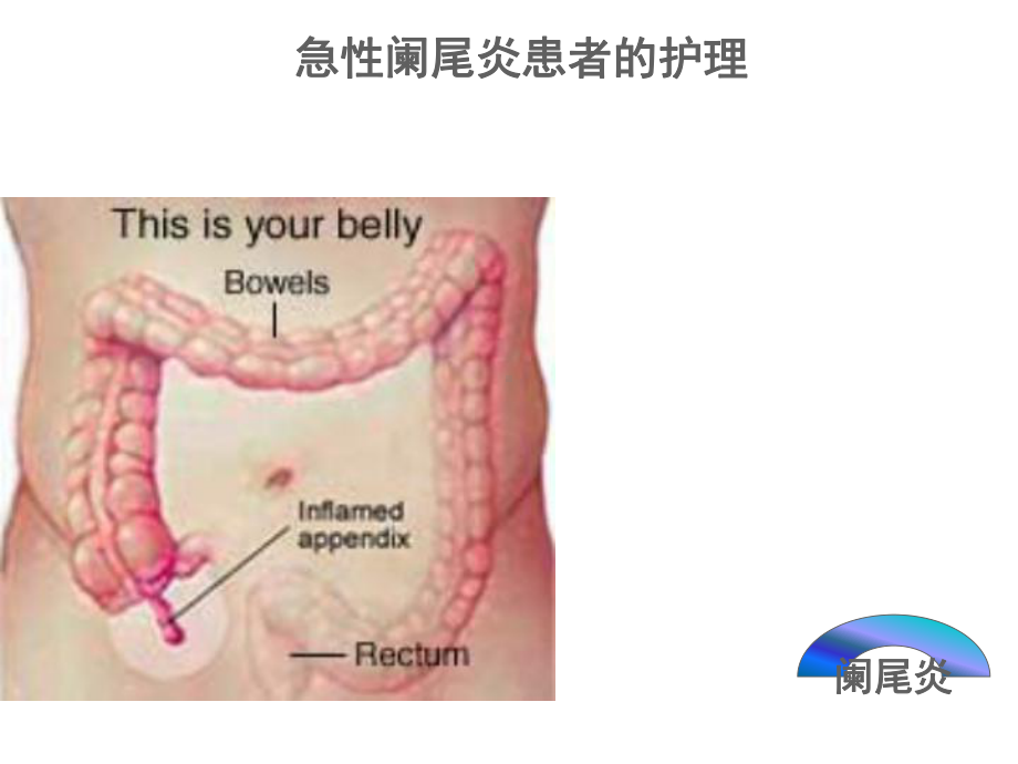 急性阑尾炎患者的护理详解课件.pptx_第1页