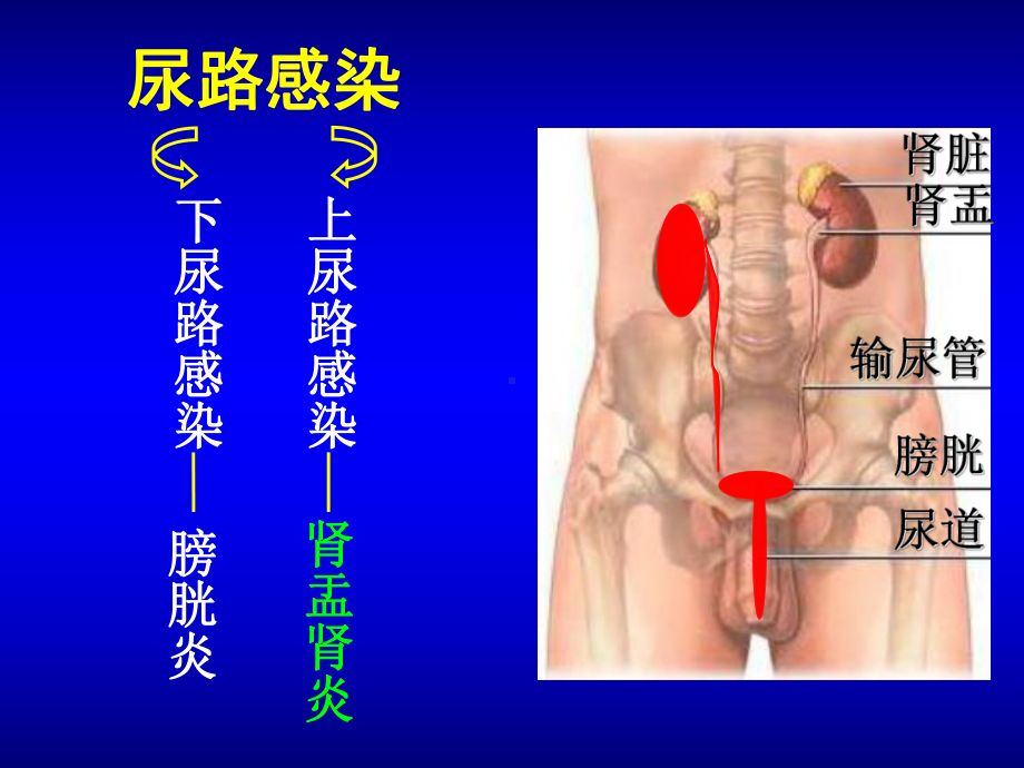 急性肾盂肾炎课件.ppt_第2页