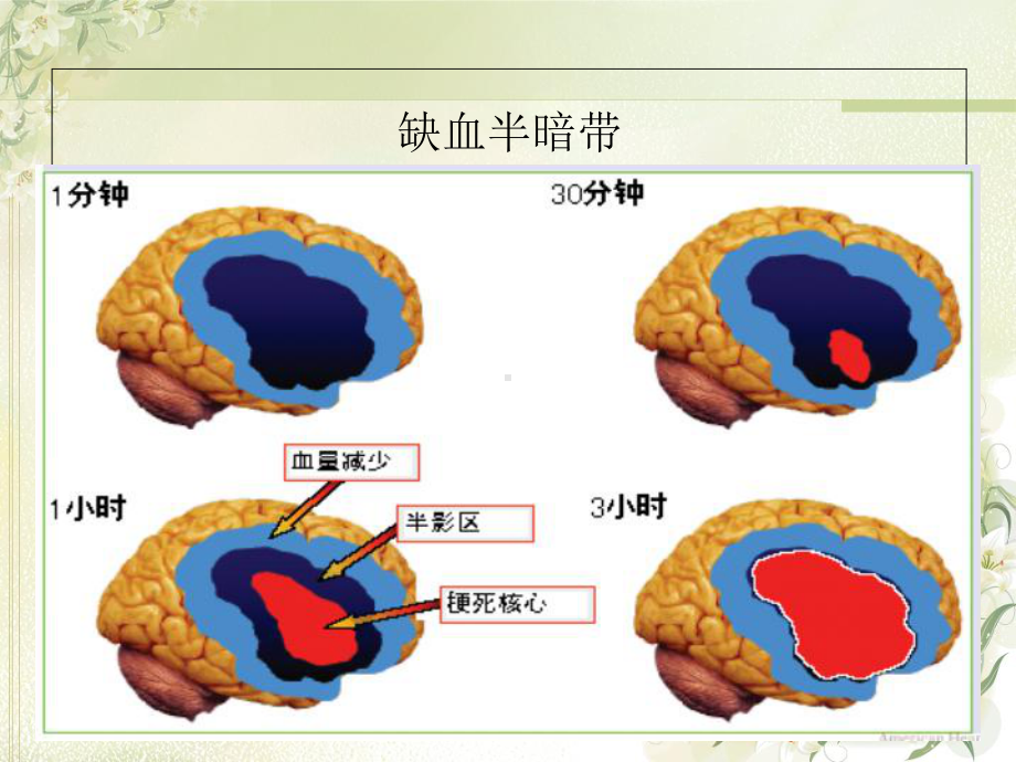 急性脑梗死静脉溶栓优质PPT课件.ppt_第2页