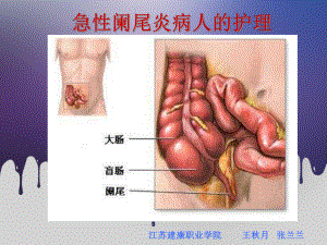 急性阑尾炎病人的护理精课件.pptx