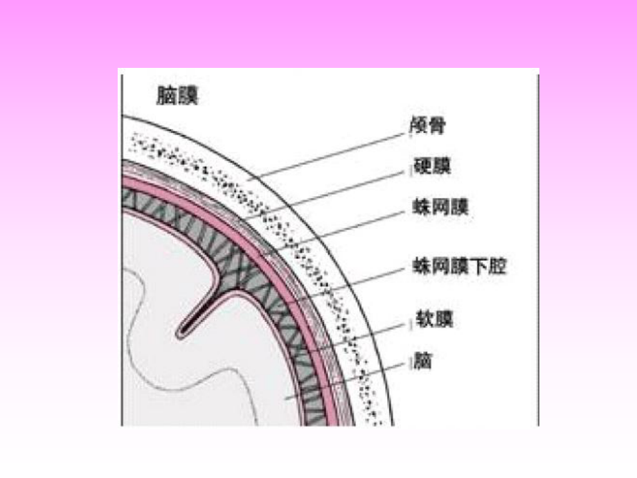 慢性硬膜下血肿的护理查房课件.ppt_第3页