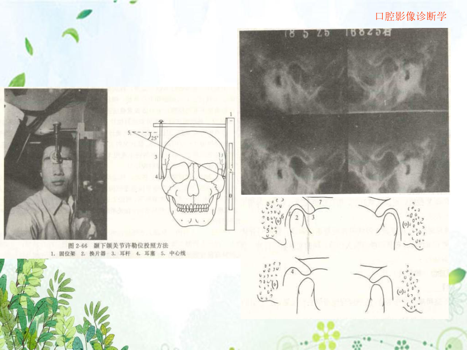 口腔颌面医学影像诊断学颞下颌关节疾病文稿演示课件.ppt_第3页