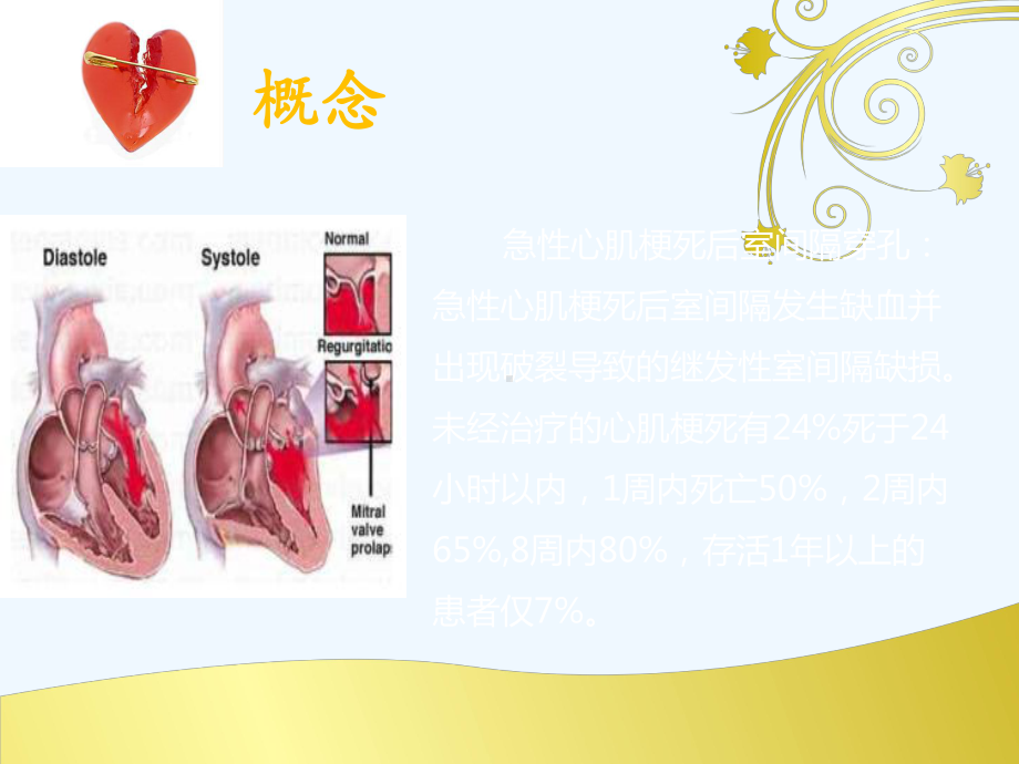 急性心肌梗死并发室间隔穿孔课件.ppt_第3页