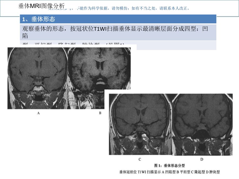 垂体增生和垂体瘤课件.ppt_第3页