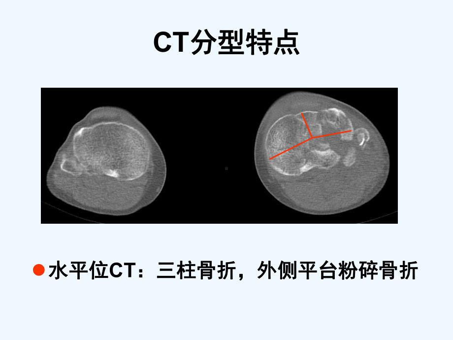 外侧扩大入路治疗胫骨平台骨折(ppt)课件.ppt_第3页