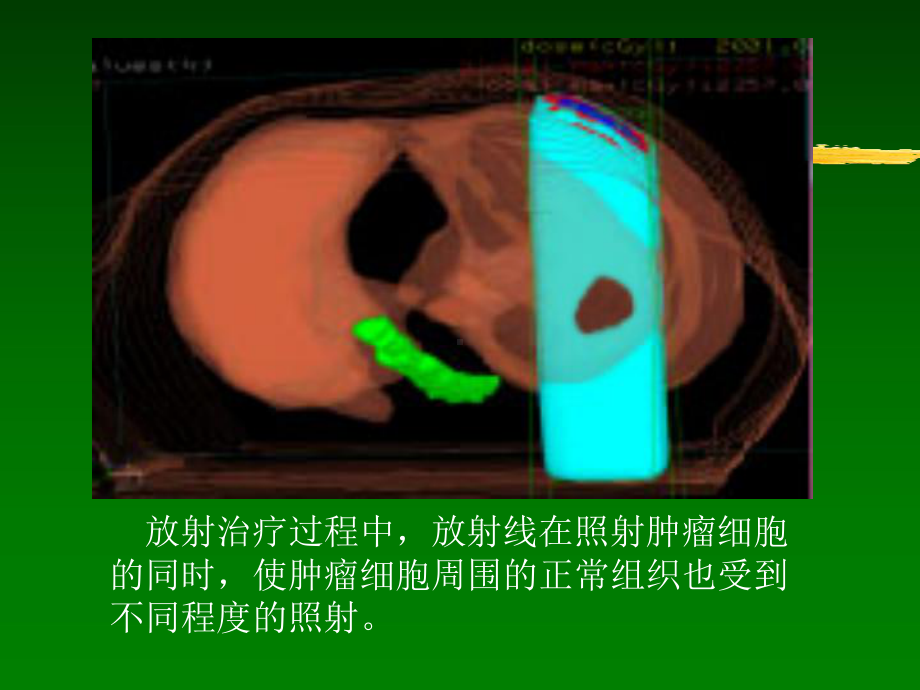 常见放射治疗技术讲义课件.ppt_第3页