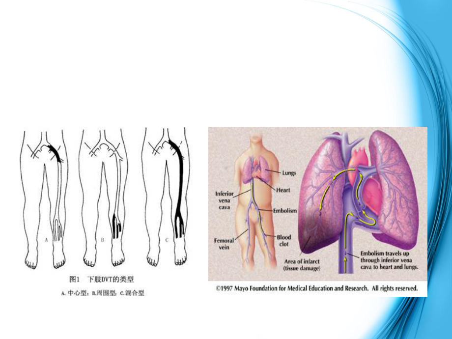 VTE的评估与预防-医学课件.ppt_第2页