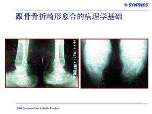 PPT医学课件陈旧性跟骨骨折的手术治疗讲义.ppt