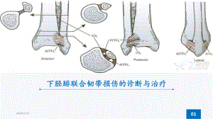 下胫腓联合韧带损伤-ppt课件.ppt