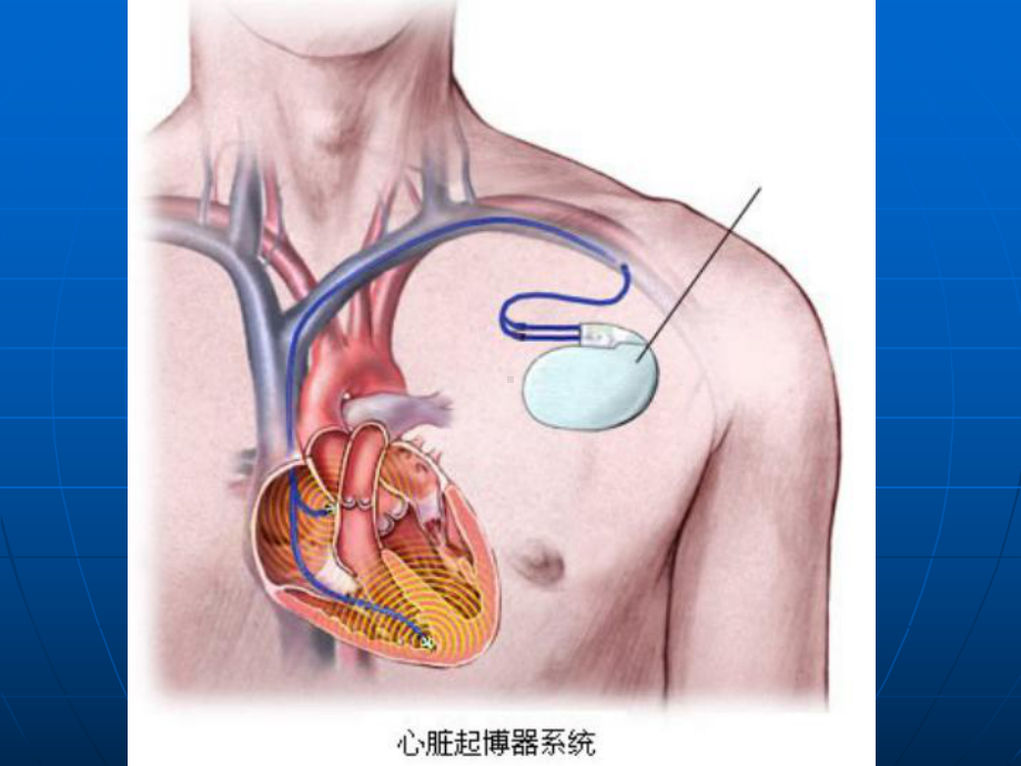 （新整理）起搏器术前术后护理ppt课件.ppt_第3页