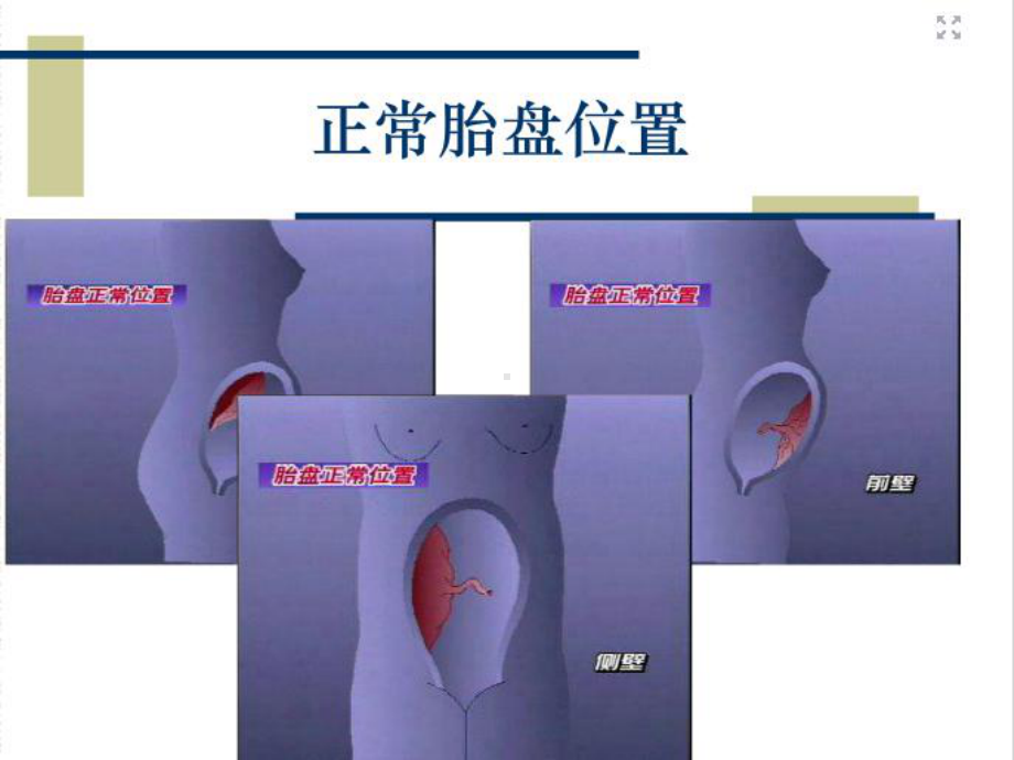 （新整理）《前置胎盘的护理》ppt课件.ppt_第2页