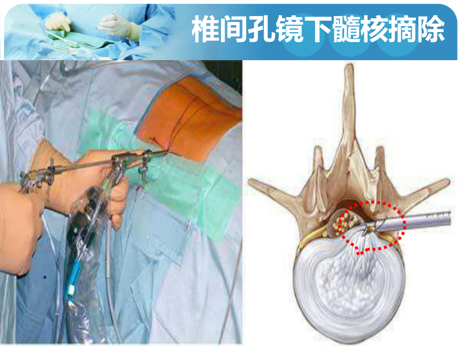 （麻醉技能学习）无痛椎间孔镜手术-复合局麻椎间孔镜课件.pptx_第3页