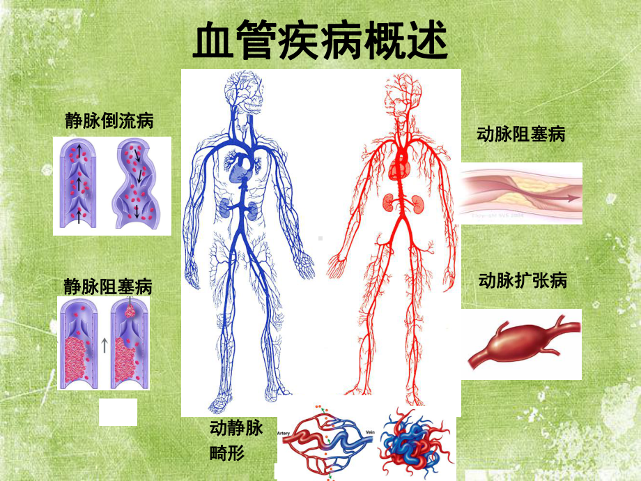 下肢血管疾病ppt课件.ppt_第2页