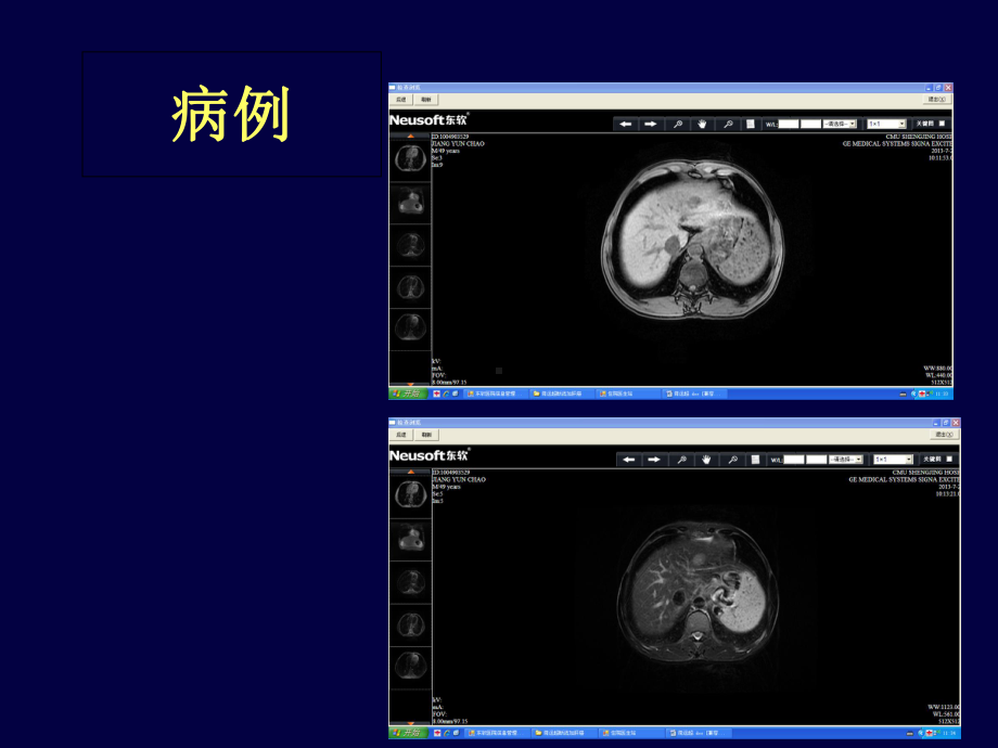 外科学门静脉高压症PPT课件.ppt_第3页