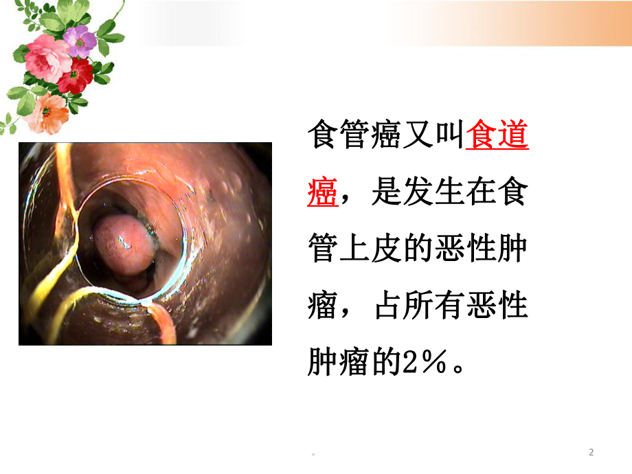 新版食管癌护理PPT课件.ppt_第2页