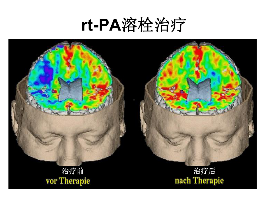 rtPA静脉溶栓的专家共识及临床治疗规范课件.pptx_第3页