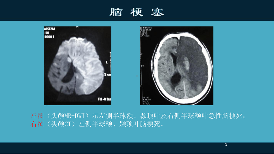 大面积脑梗塞最新ppt课件.ppt_第3页