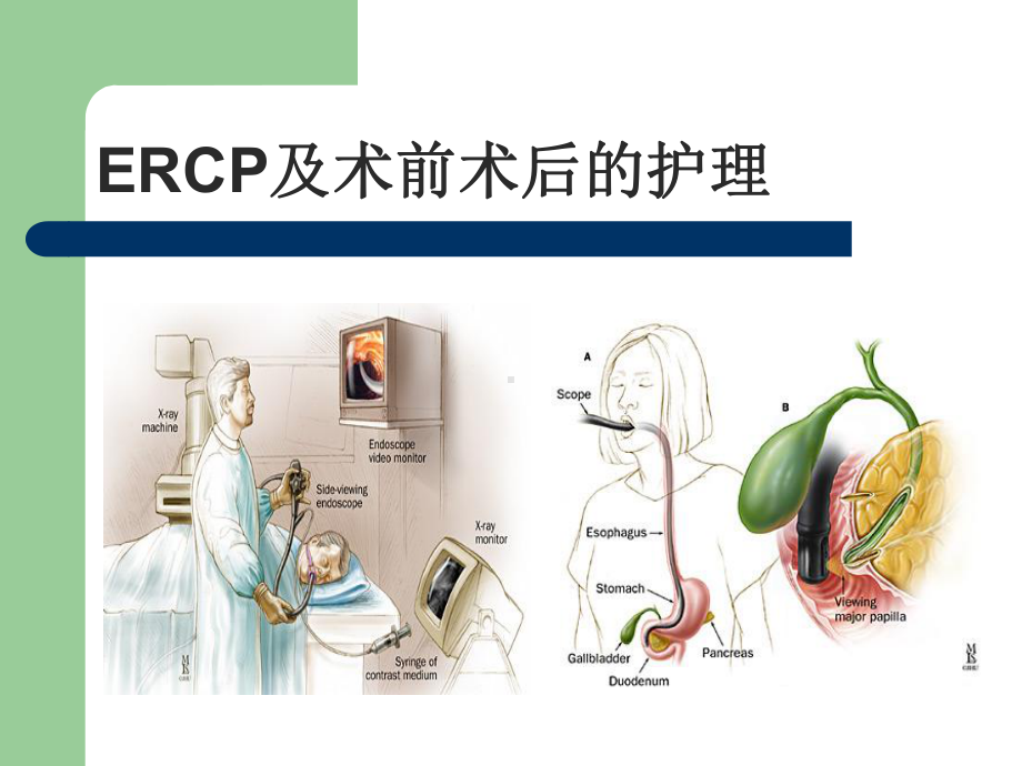 ERCP及术前术后护理查房教学ppt课件.pptx_第1页