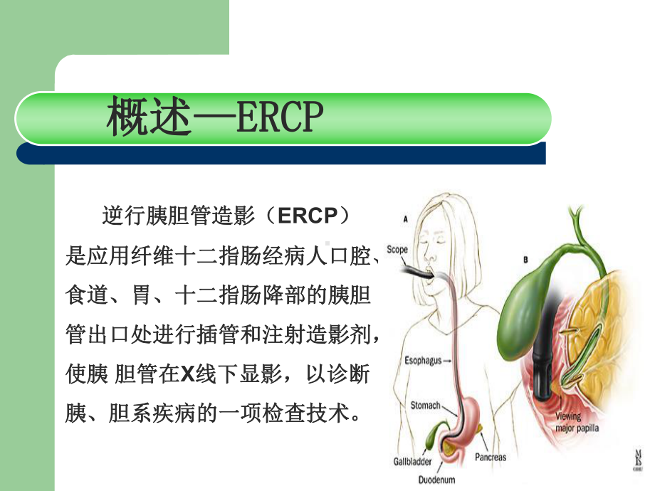 ERCP及术前术后护理查房教学ppt课件.pptx_第3页