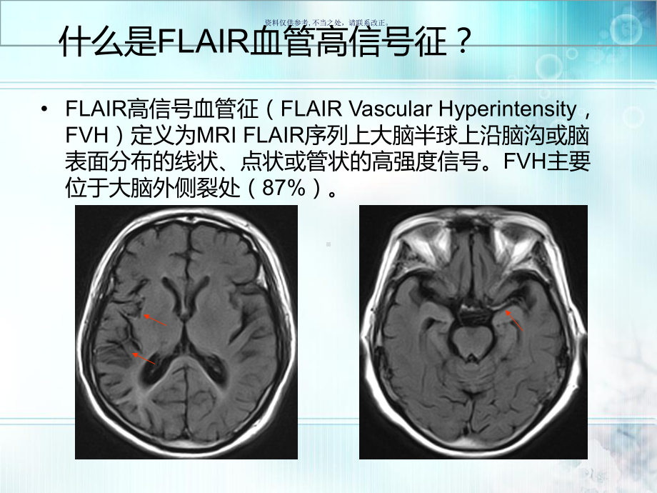 FLAIR血管高信号征对急性前循环脑梗死的临床评价作用课件.ppt_第2页