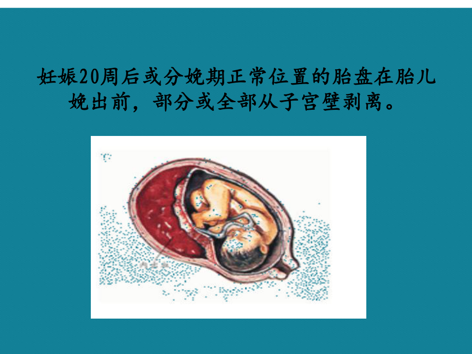 (优选)妇产科学胎盘早剥前置胎盘课件.ppt_第2页