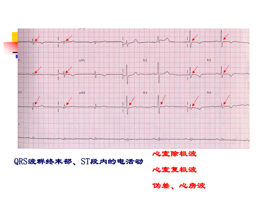 QRS后特殊波的分析课件.pptx_第1页