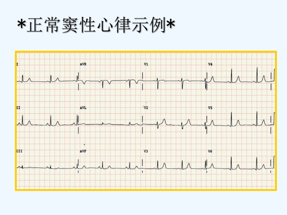 临床常见心电图判读ppt.(ppt)课件.ppt_第2页