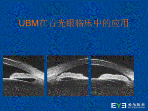 UBM在青光眼临床中应用课件.ppt