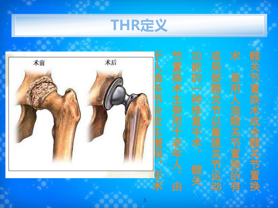 人工髋关节置换术课件.ppt_第3页