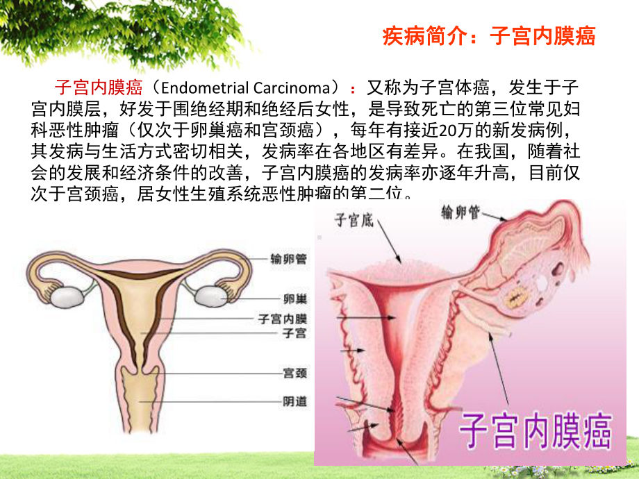 子宫内膜癌术后护理查房课件.pptx_第3页