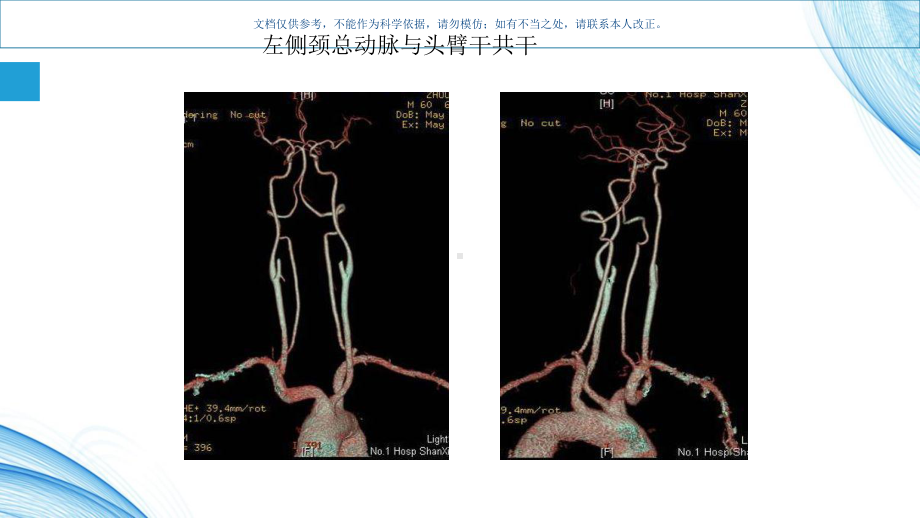 头颈部血管变异课件.ppt_第3页