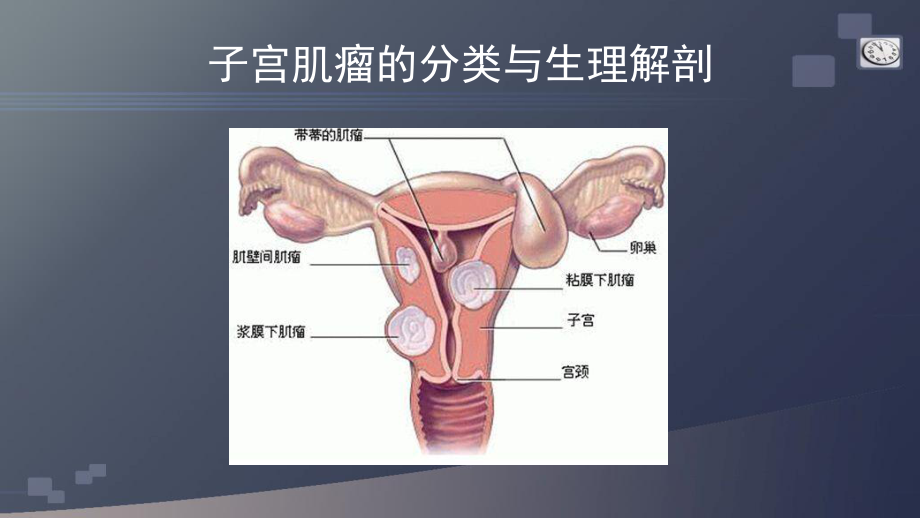 子宫肌瘤的护理查房-PPT课件.pptx_第3页