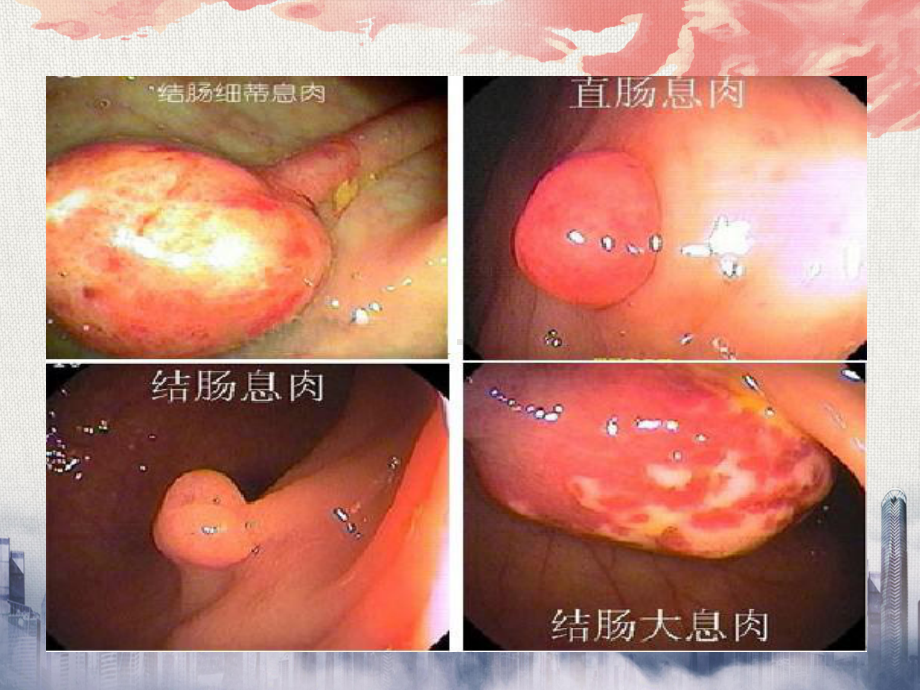 教学查房结肠息肉课件.ppt_第3页