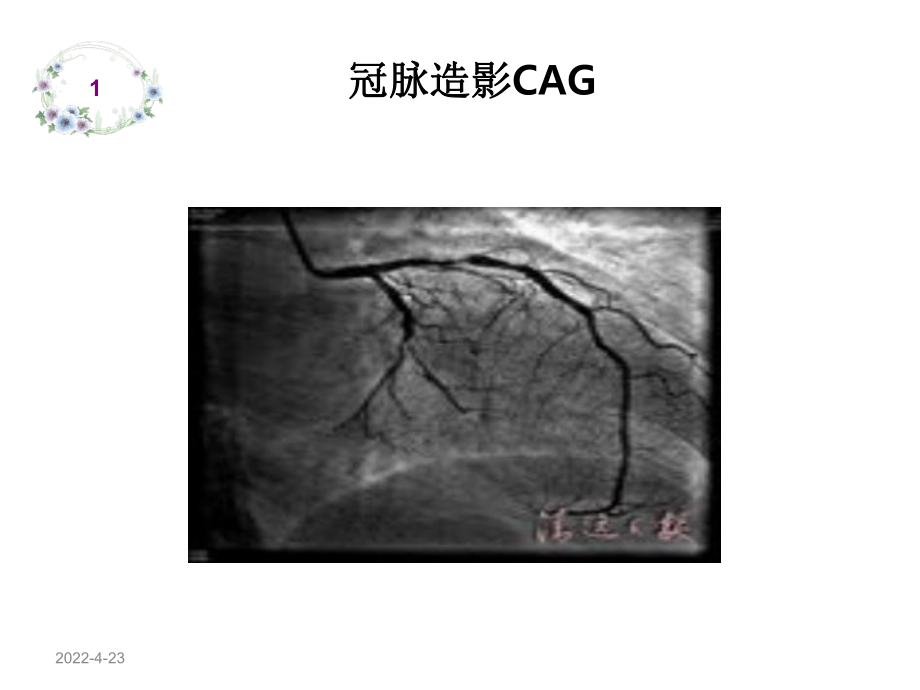 冠脉造影护理课件.pptx_第3页