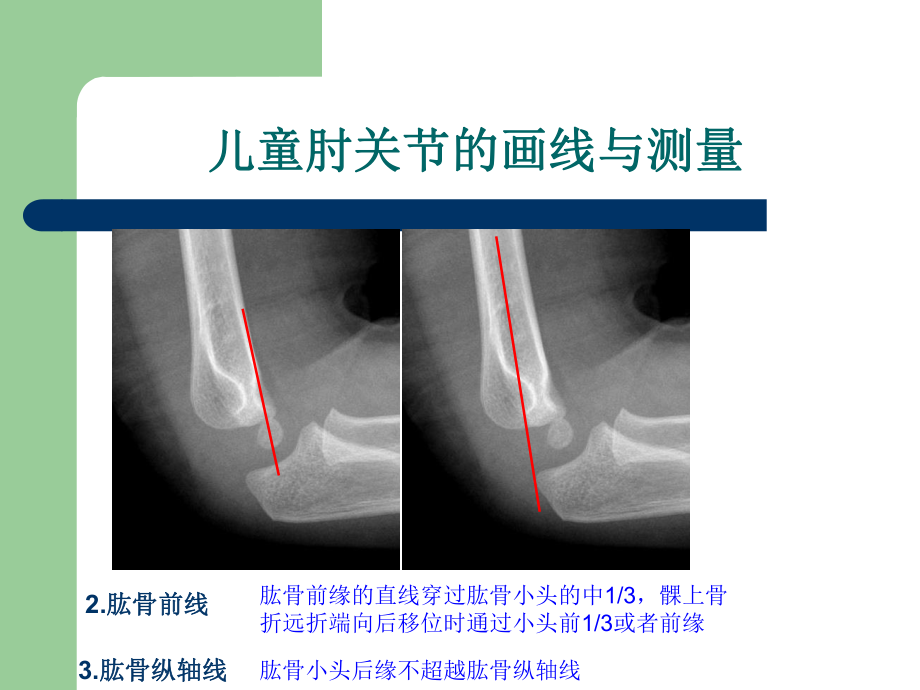 儿童肘关节损伤X线诊断解析课件.ppt_第3页